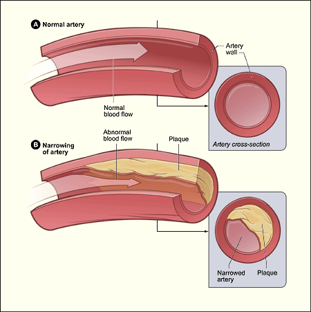 Atherosclerosis - ather_lowres